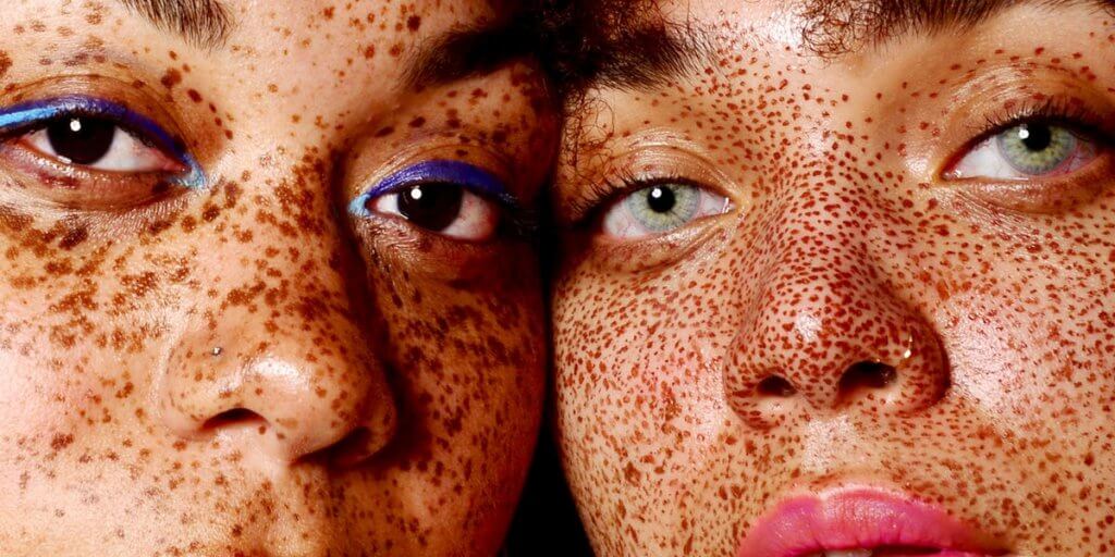 Faces affected by freckles
